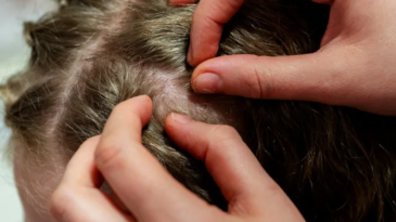 piolhos-conheca-formas-mais-eficazes-de-prevencao