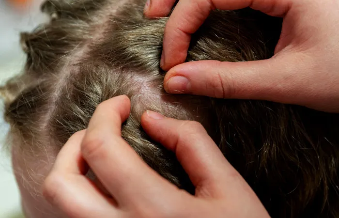 piolhos-conheca-formas-mais-eficazes-de-prevencao